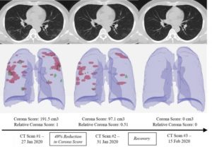 AI-Powered CT Imaging System Shown to Detect COVID-19